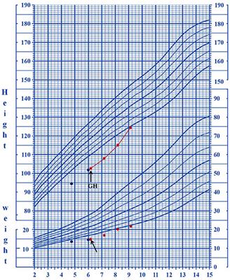 De Novo CSNK2B Mutations in Five Cases of Poirier–Bienvenu Neurodevelopmental Syndrome